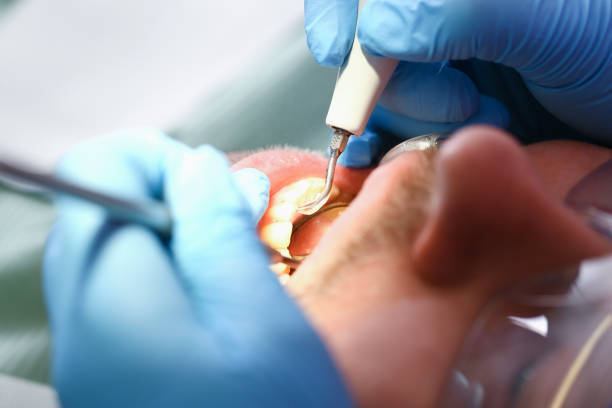 Best Emergency Wisdom Tooth Extraction in Olympia, SC